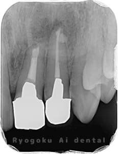 歯根端切除法の術後レントゲン