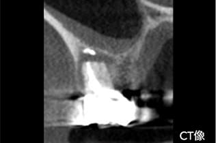 CT検査