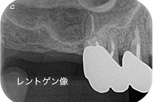 6ヶ月後にレントゲン検査