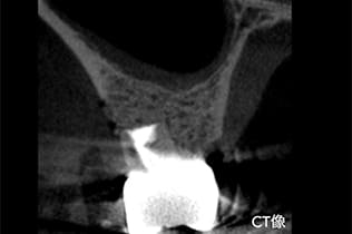 6ヶ月後にCT検査