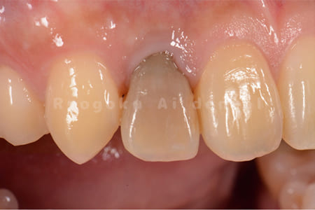 歯の神経が死んでしまったことによる変色