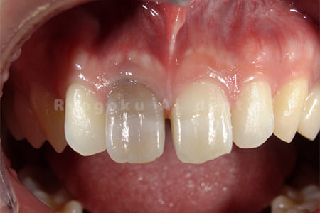 歯の神経が死んでしまったことによる変色