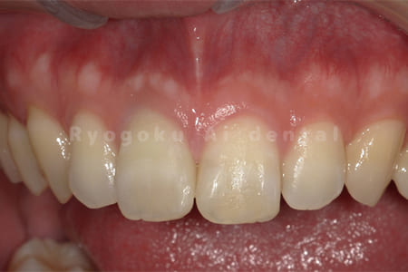 根管治療＋ブリーチング＋ダイレクトボンディング