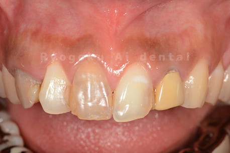 歯の神経が死んでしまったことによる変色