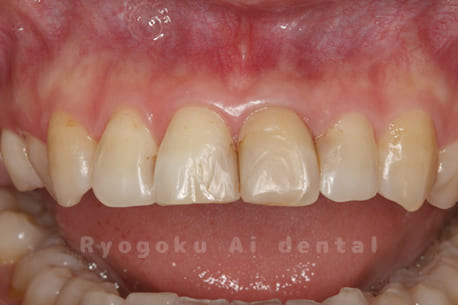 失活による歯牙変色