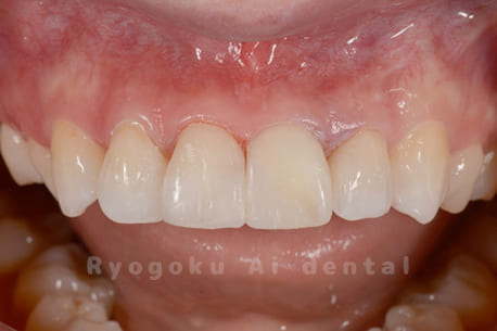 ブリーチング＋マイクロエンド＋ダイレクトボンディング＋ホワイトニング