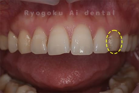 失活による歯牙変色