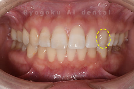 ブリーチング＋ダイレクトボンディング