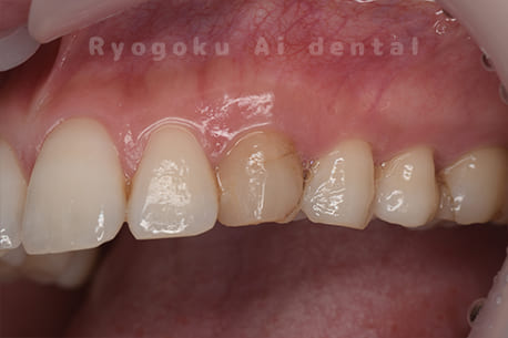 失活による歯牙変色