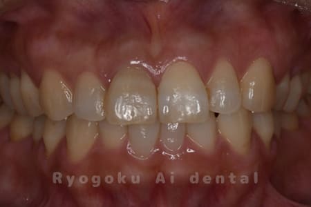 前歯部失活歯による変色