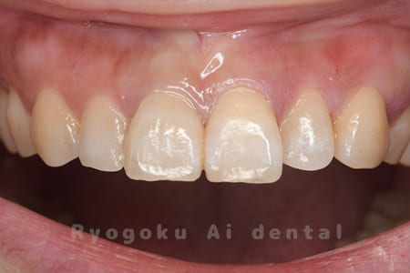 根管治療ならびに、ダイレクトボンディング、ブリーチング