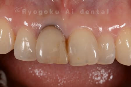 失活歯による歯の変色