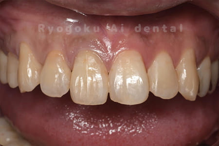 ダイレクトボンディング、マイクロエンド、ブリーチング