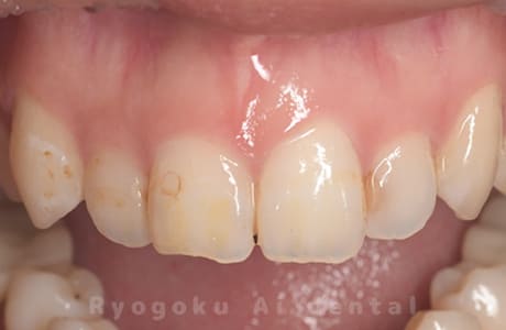 ダイレクトボンディング、マイクロエンド、ブリーチング