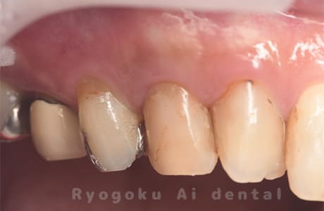 失活歯による歯牙変色