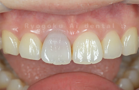 失活歯による歯牙変色