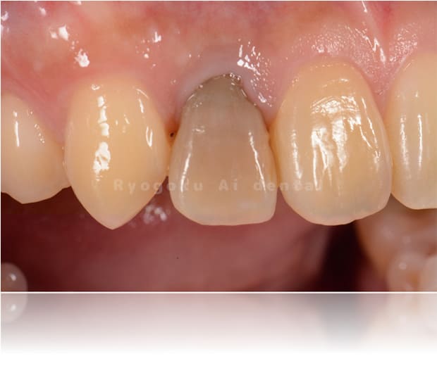 失活歯のブリーチング