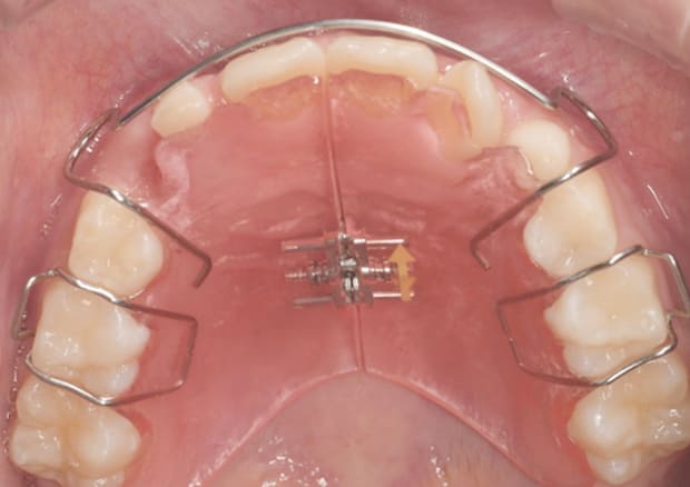 子どもの成長を活かした床矯正