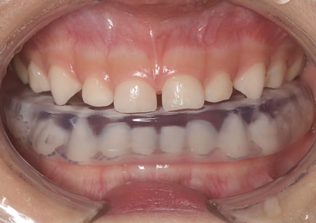 3～6歳のお子様適用のVキッズ