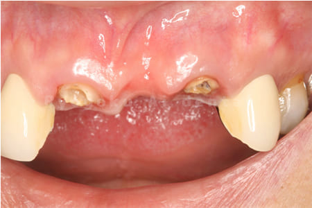 重度縁下カリエス