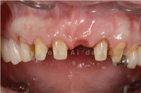 クラウンレングスニング＋歯周外科