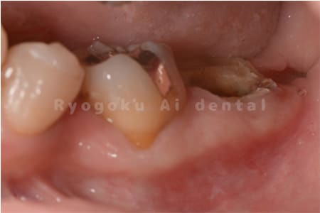 重度縁下カリエス、慢性根尖性歯周炎