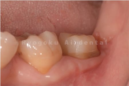 クラウンレングスニング＋歯周外科＋マイクロエンド