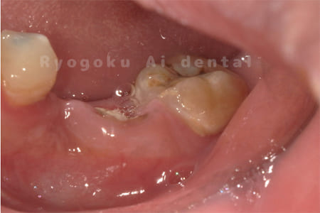 重度縁下カリエス