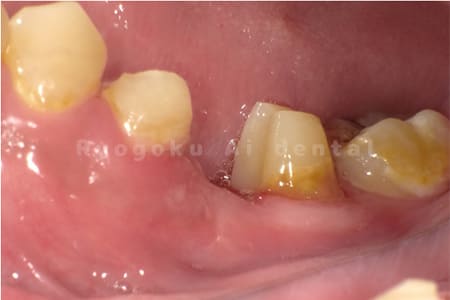 クラウンレングスニング＋歯周外科