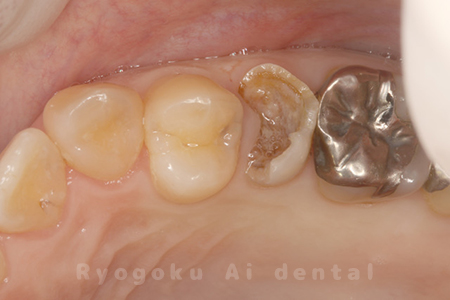 咬合面・重度カリエス、C3急化Pul