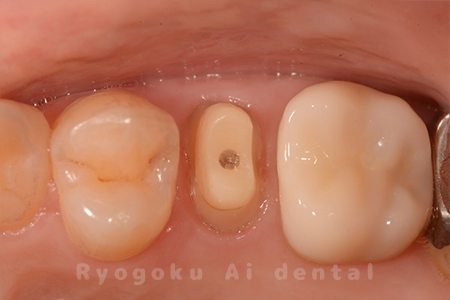 咬合面・クラウンレングスニング
