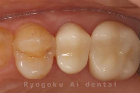 咬合面・セラミッククラウン装着