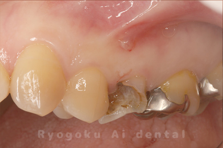 重度カリエス、C3急化Pul
