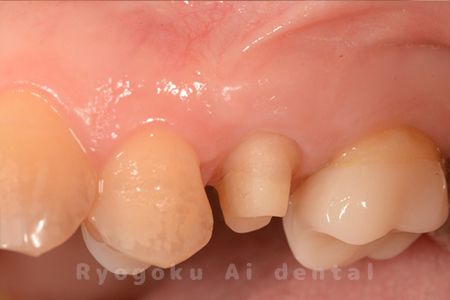 クラウンレングスニング