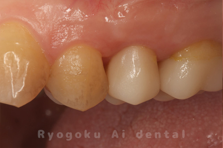 セラミッククラウン装着