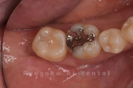 クラウンレングスニング＋ダイレクトボンディング