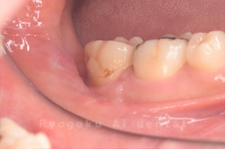 クラウンレングスニング術後