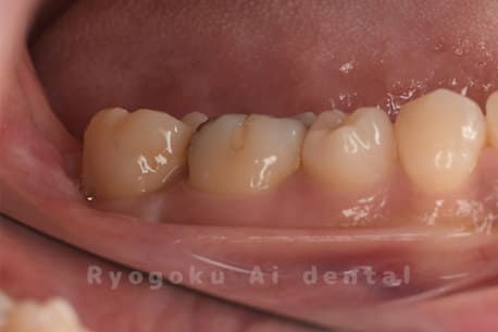 クラウンレングスニング＋ダイレクトボンディング術後