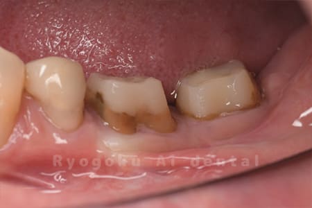 クラウンレングスニング