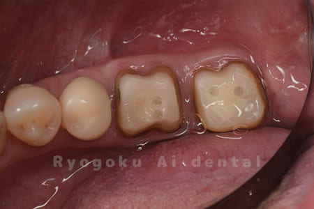 クラウンレングスニング