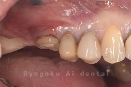 左上６番重度カリエス