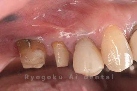 クラウンレングスニング