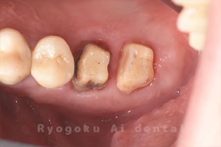 クラウンレングスニング