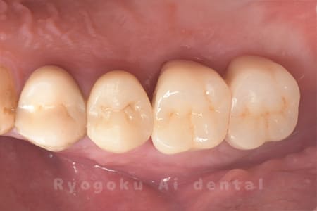 クラウンレングスニング、ジルコニアクラウン治療