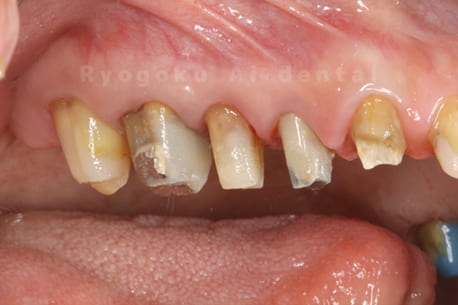 クラウンレングスニング治療