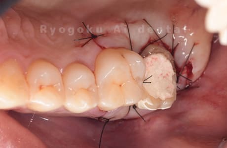 クラウンレングスニング
