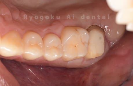 クラウンレングスニング