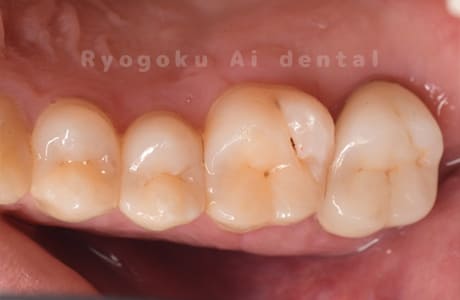 クラウンレングスニング、ジルコニアクラウン修復