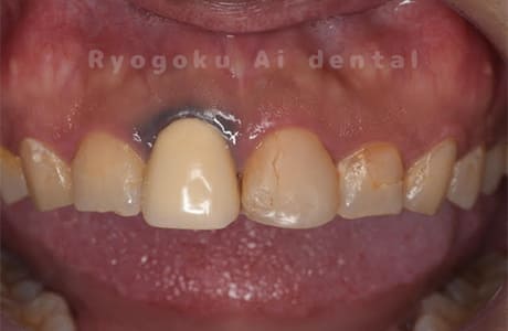 前歯部不良補綴