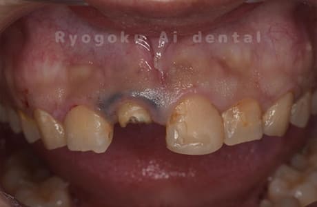 前歯部不良補綴除去